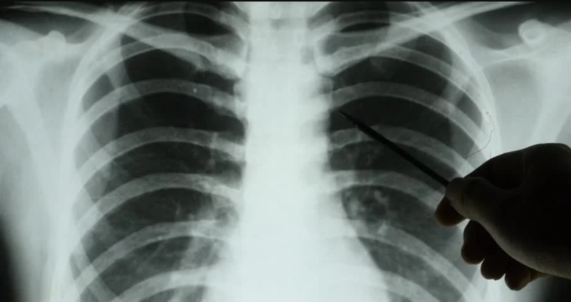 Рентгенологам стала доступна ИИ-диагностика перелома рёбер – мэрия Москвы